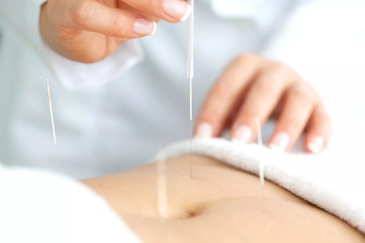 Acupuncture and Fertility