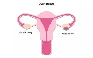 Ovarian Cysts and Fertility